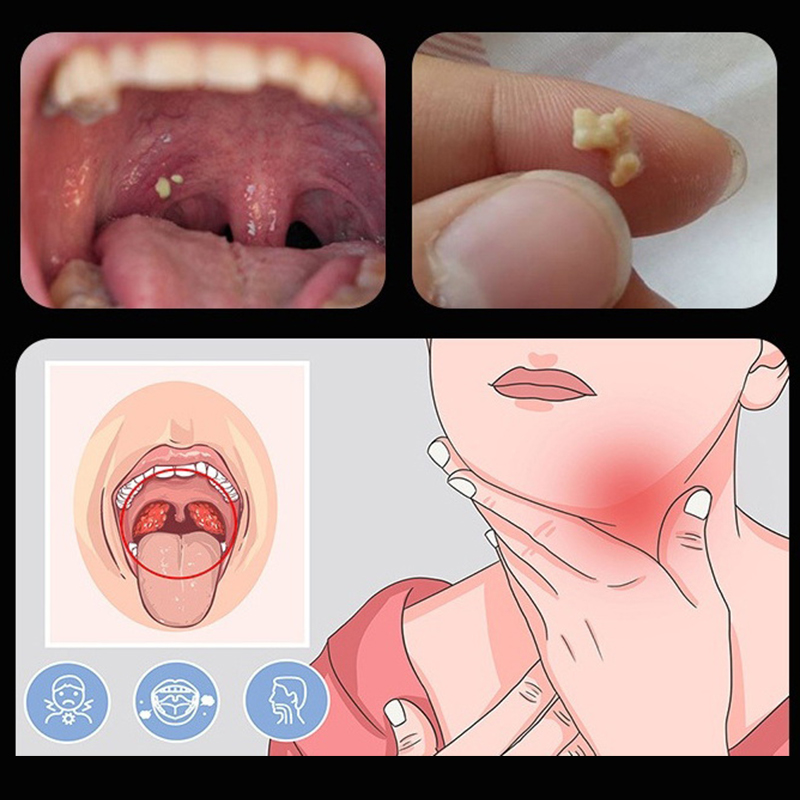 ~Ear Wax Tonsil Stone Remover  - Ear Wax Remover ulasan dan harga